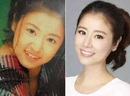 明星牙齿整形对比照,见证蜕变之美